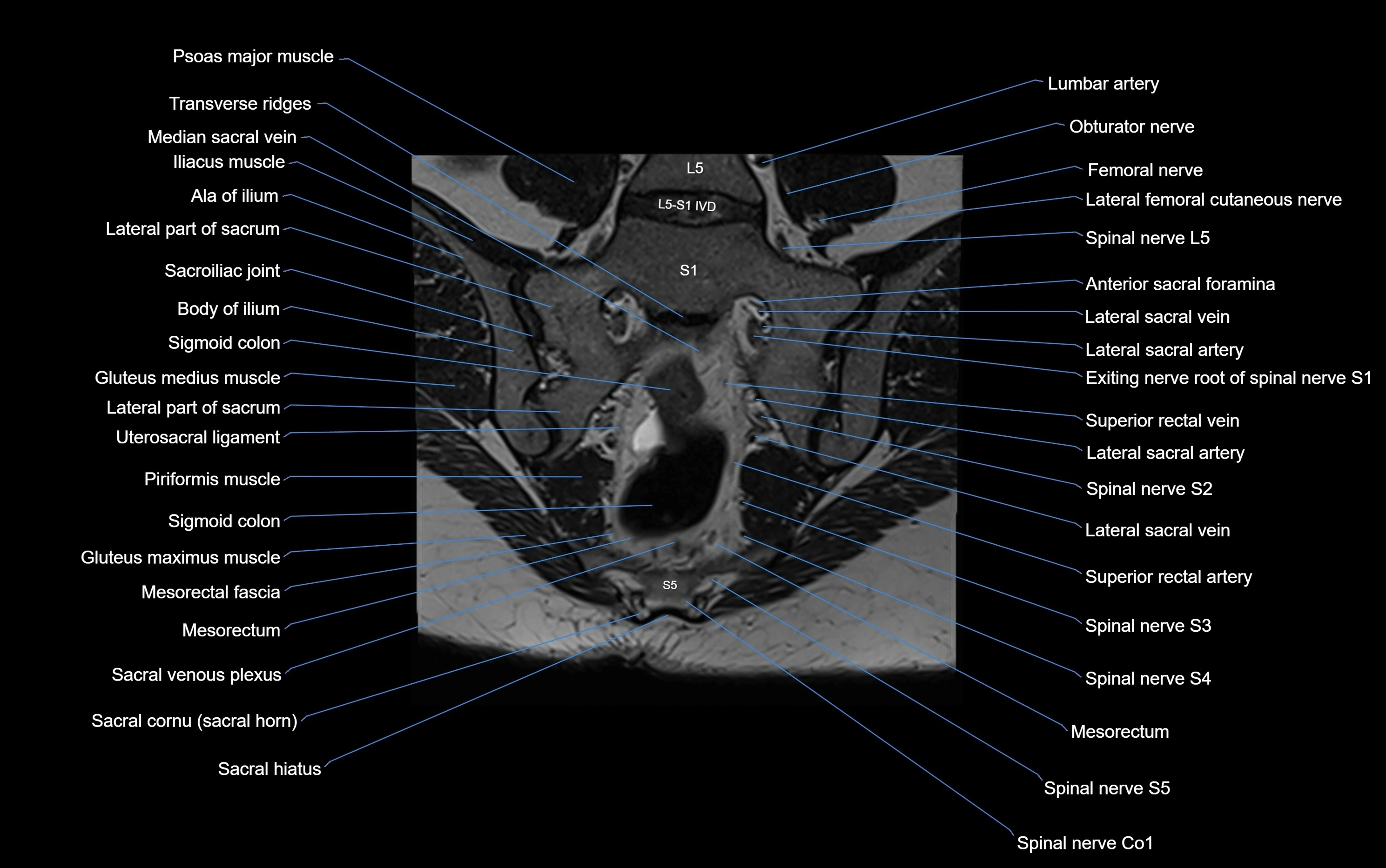 MRI sacroiliac joint coronal cross sectional anatomy  radiology  image-img-00001-00016.webp